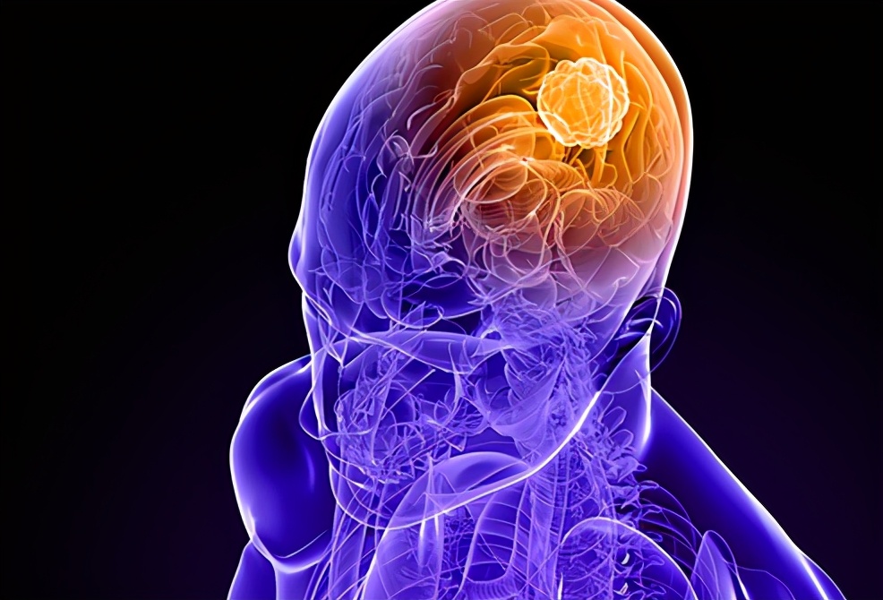大脑是人体司令部，出现脑癌常会引起头痛等异常，该如何正确应对