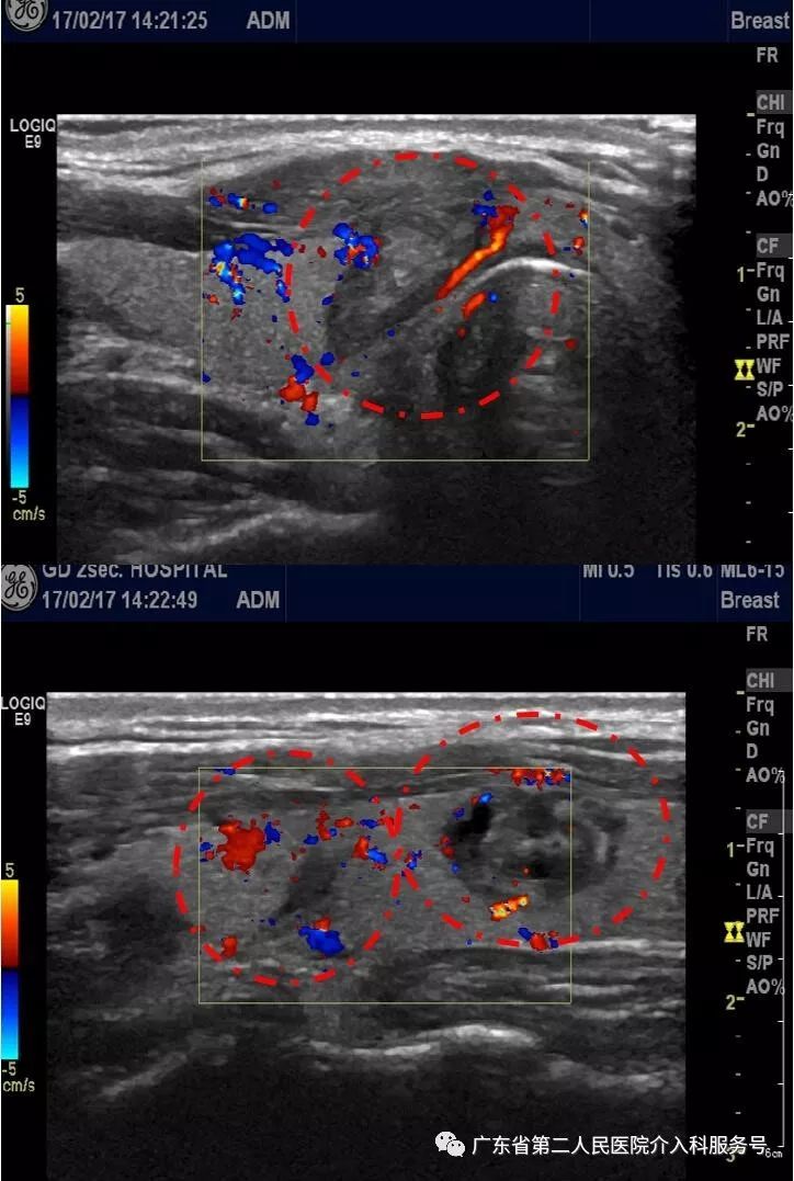 甲状腺结节观察与药物治疗2年能否缩小？微创消融治疗3年后如何？