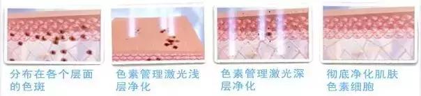 激光祛斑后的护理怎么做,皮秒激光祛斑术后护理