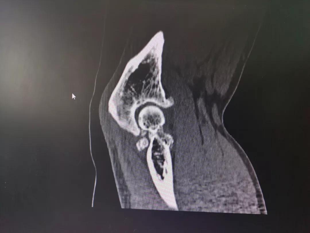 肩袖损伤肘关节旋转康复训练,肩关节损伤治疗微创视频