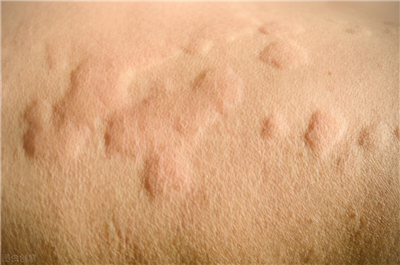 麻疹痒怎么缓解还有点晕,荨麻疹奇痒难耐该怎么办