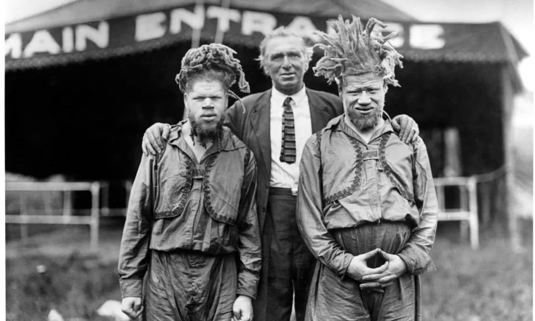 患上白化病不能使黑人免受歧视，他们沦为了同族人的”猎物“