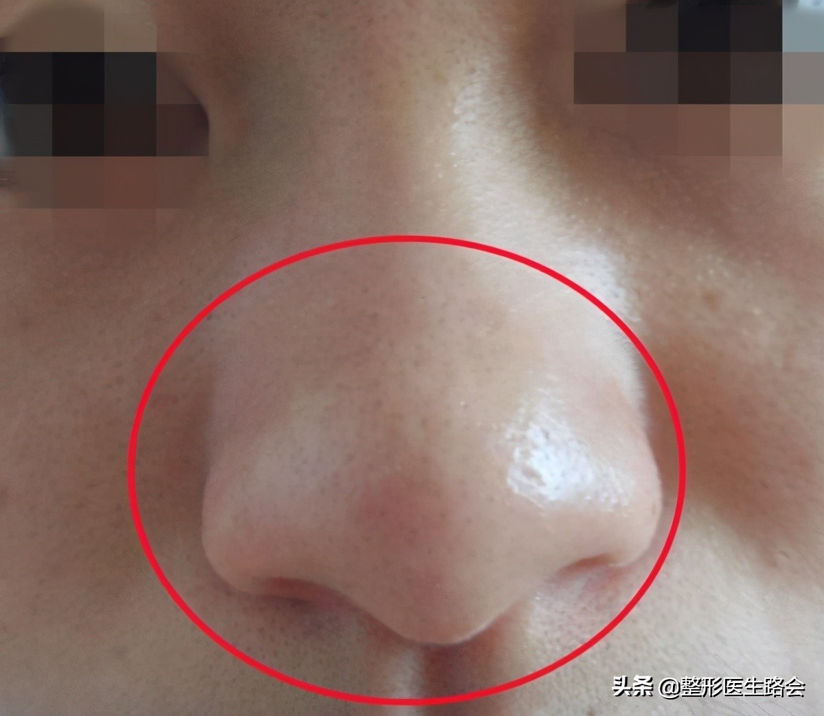 挤黑头鼻头大会变小,挤黑头鼻头会越来越大吗