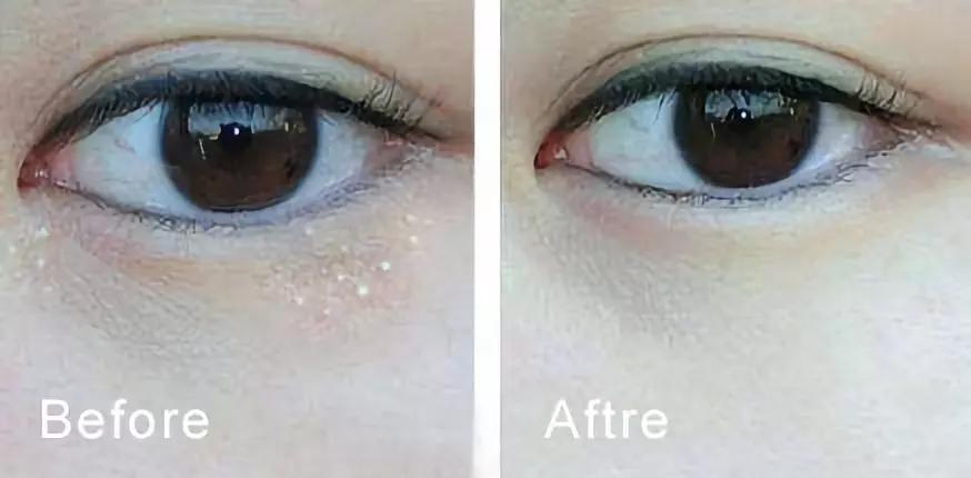 脂肪粒怎么用针挑出的,脂肪粒多久可以用针挑出来