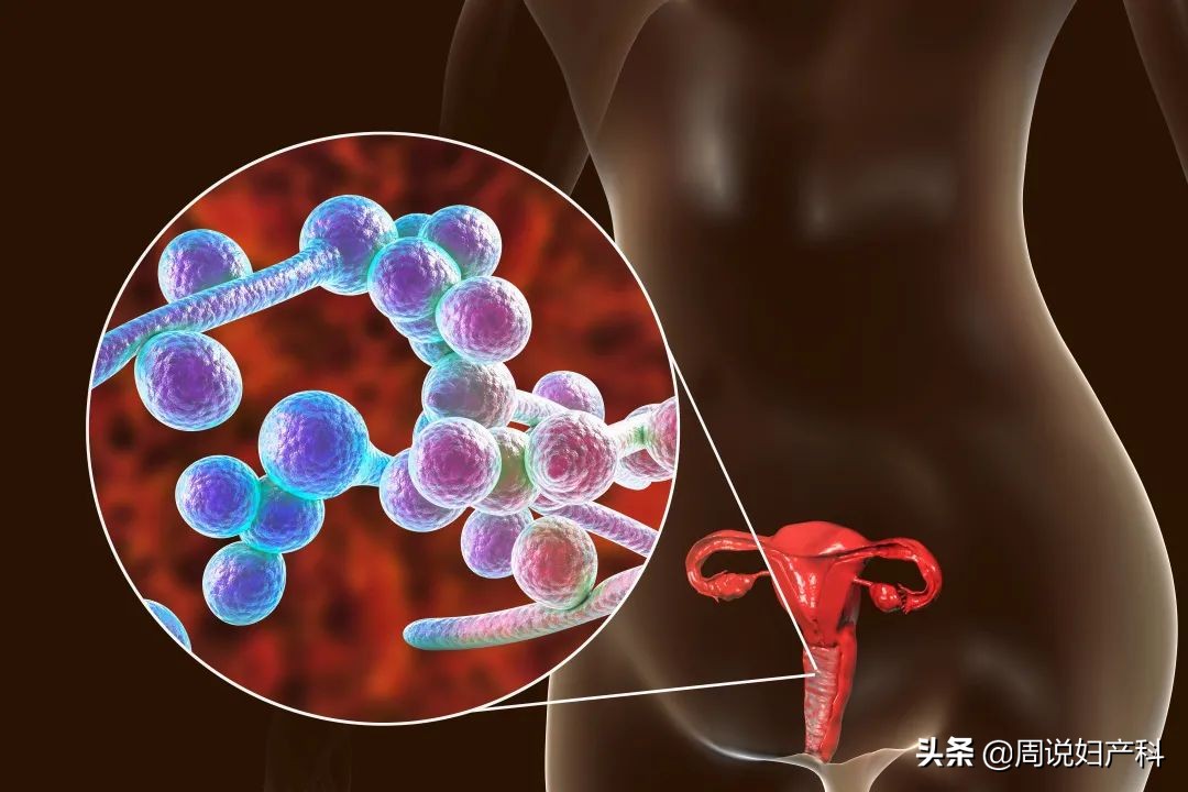 女生得阴道炎跟不自爱没关系，而是跟这3点有关系
