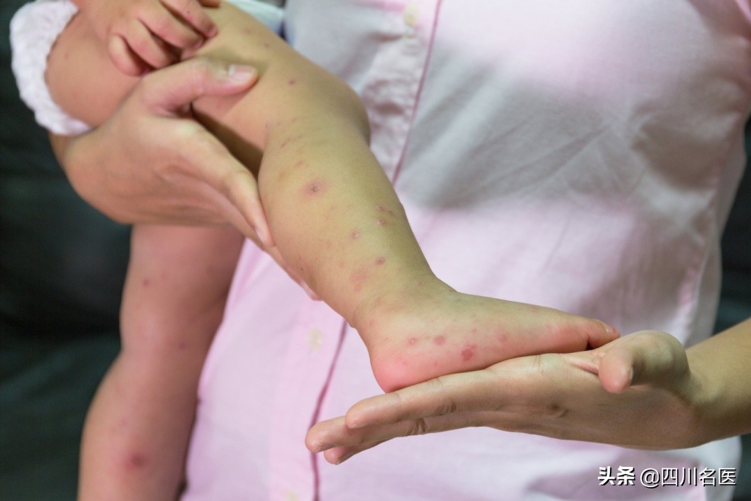 2岁孩子病毒发烧39度反反复复,小孩疱疹一直高烧39以上怎么办