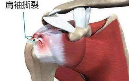 肩周炎为什么难治疗,肩周炎为什么总治不好