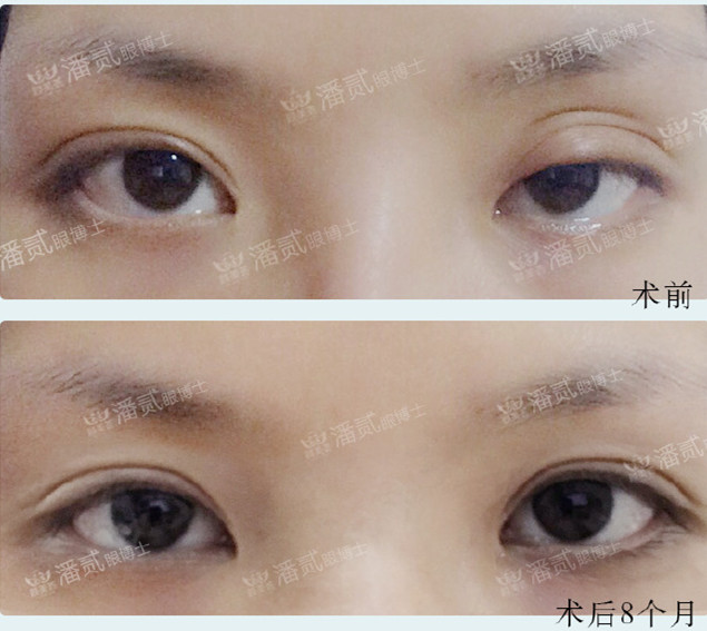 双眼皮修复有失败的吗,双眼皮修复失败了会怎样