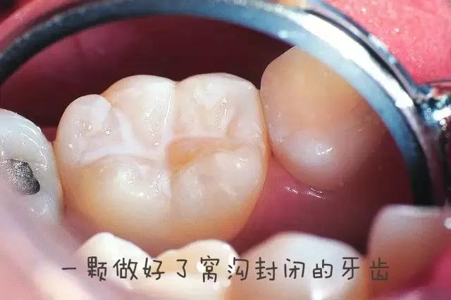 什么是儿童窝沟封闭?会不会痛?1分钟视频带你看懂#雅悦齿科#