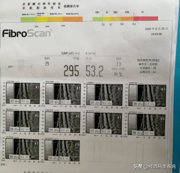 酒依赖患者戒断症状的护理,典型病例分享护理
