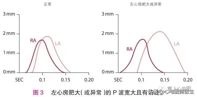 左右心室肥大发病原因,心脏肥大可以瘦回来吗