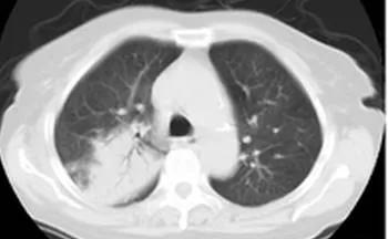 探究肺炎,儿童肺炎支气管镜利弊分析