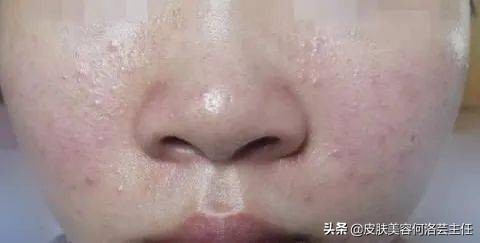 痘痘反反复复，脸上坑坑洼洼，到底是什么原因？