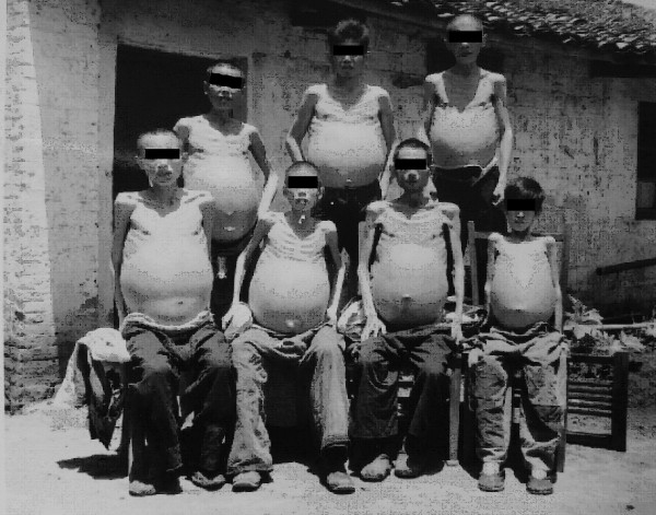 血吸虫会让肚子变大吗,血吸虫为何导致大肚子