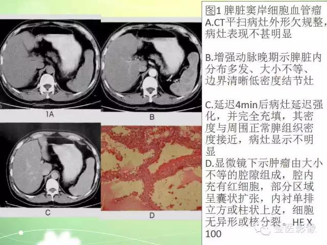 脾血管瘤中医辨证,脾血管瘤超声表现