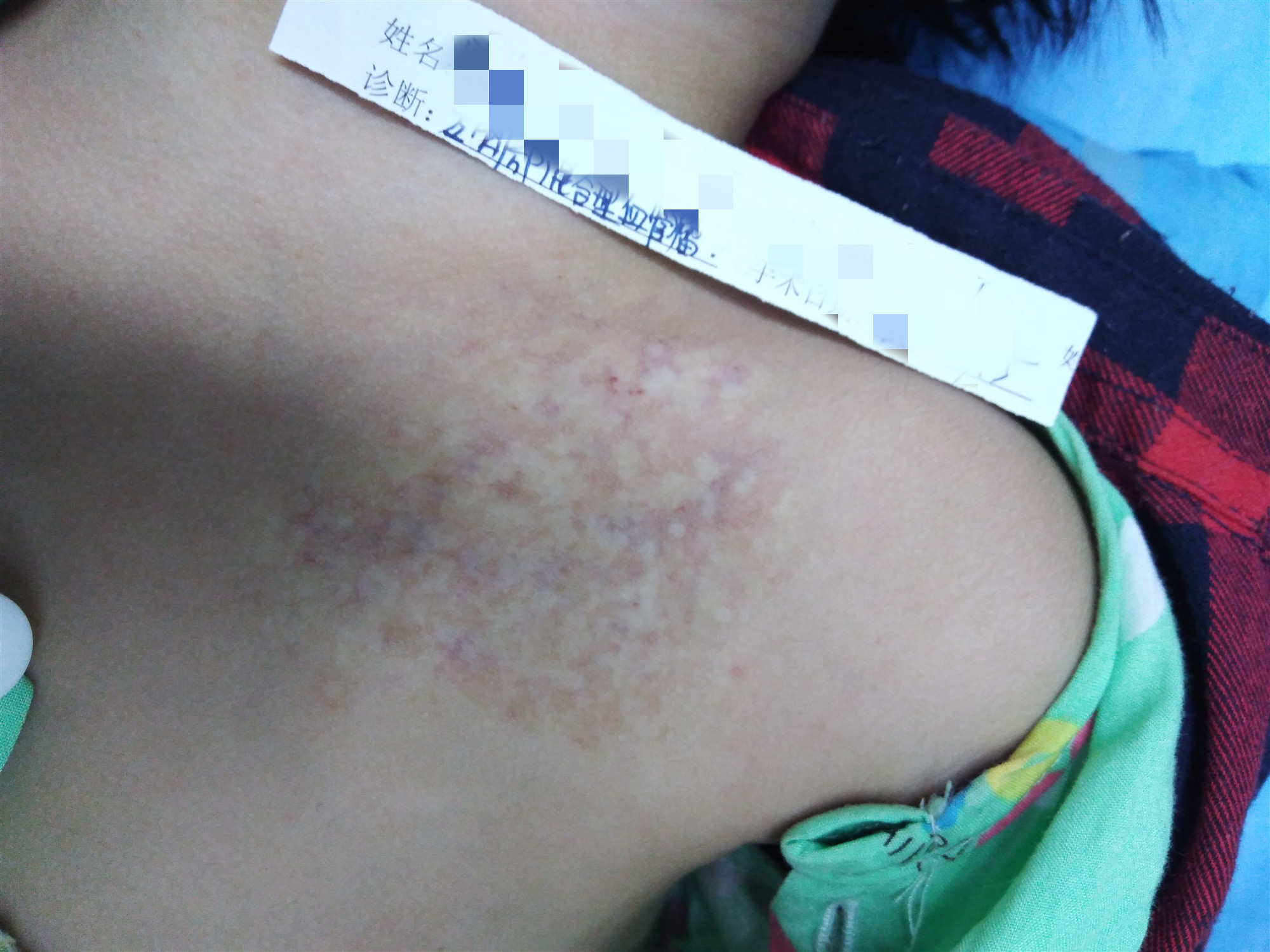 2岁女儿血管瘤,2岁小女孩肝血管瘤