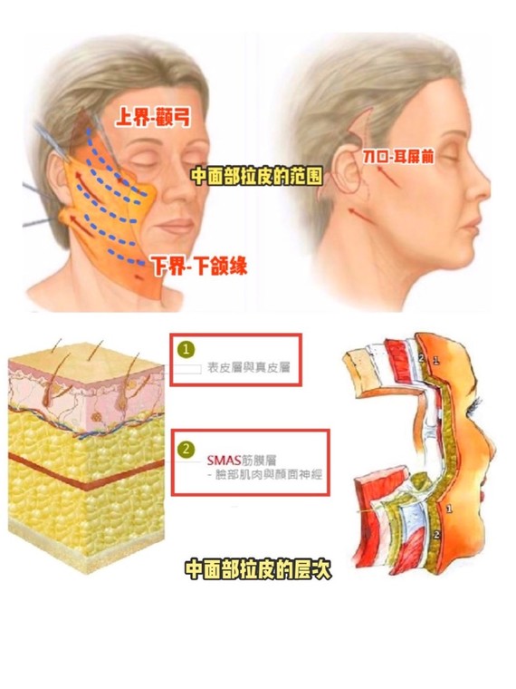 拉皮手术真人讲述案例,拉皮手术真实恢复期案例