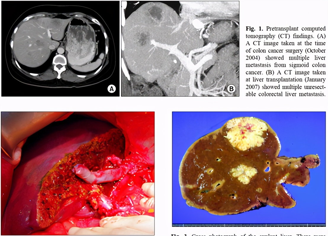 肝移植成功事例,中医治疗结肠癌肝转移的存活率