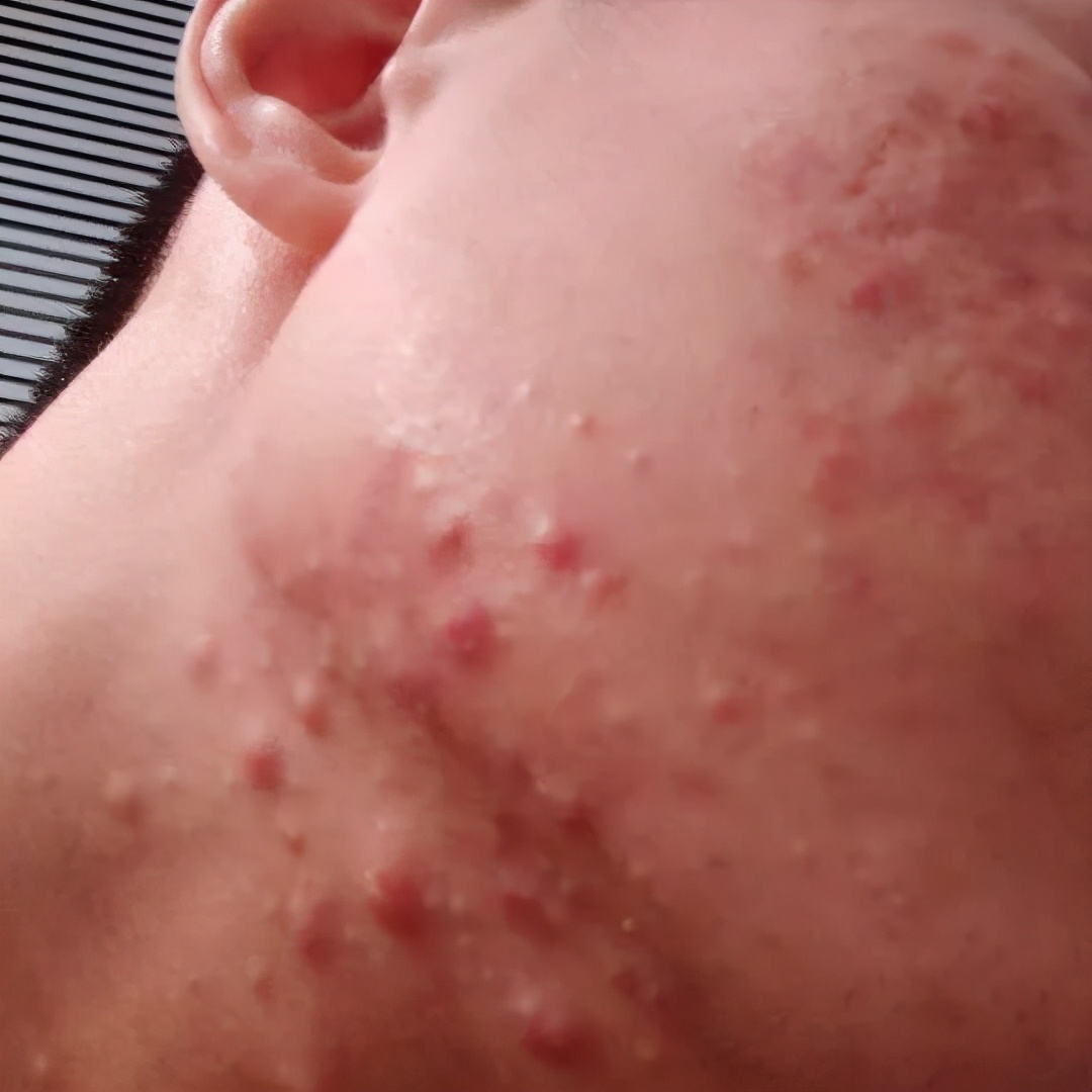 清理严重粉刺痘痘,严重的痘痘去除视频