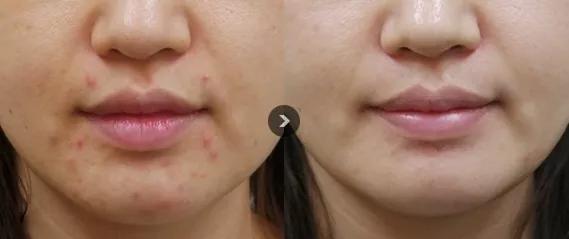 水光针真的比面膜好吗,1次水光等于1000张面膜