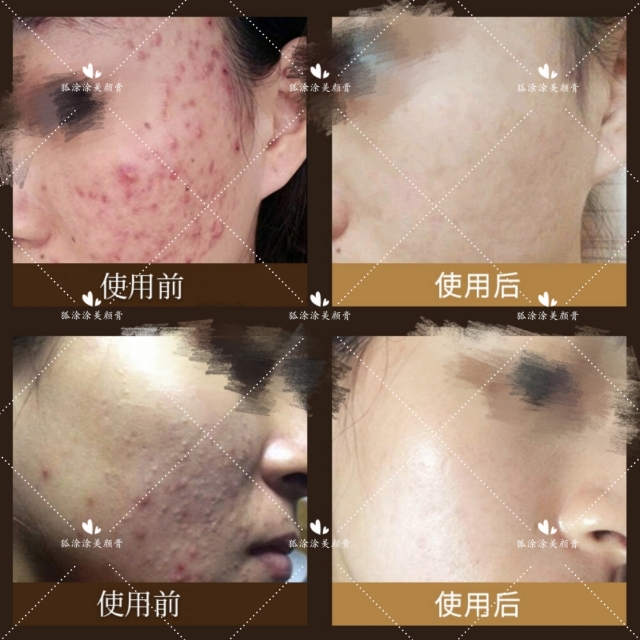 祛痘印痘坑用什么产品最好,什么产品祛痘印和祛痘最好最快