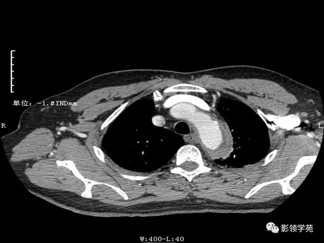 主动脉壁间血肿护理查房,主动脉夹层和壁间血肿图片