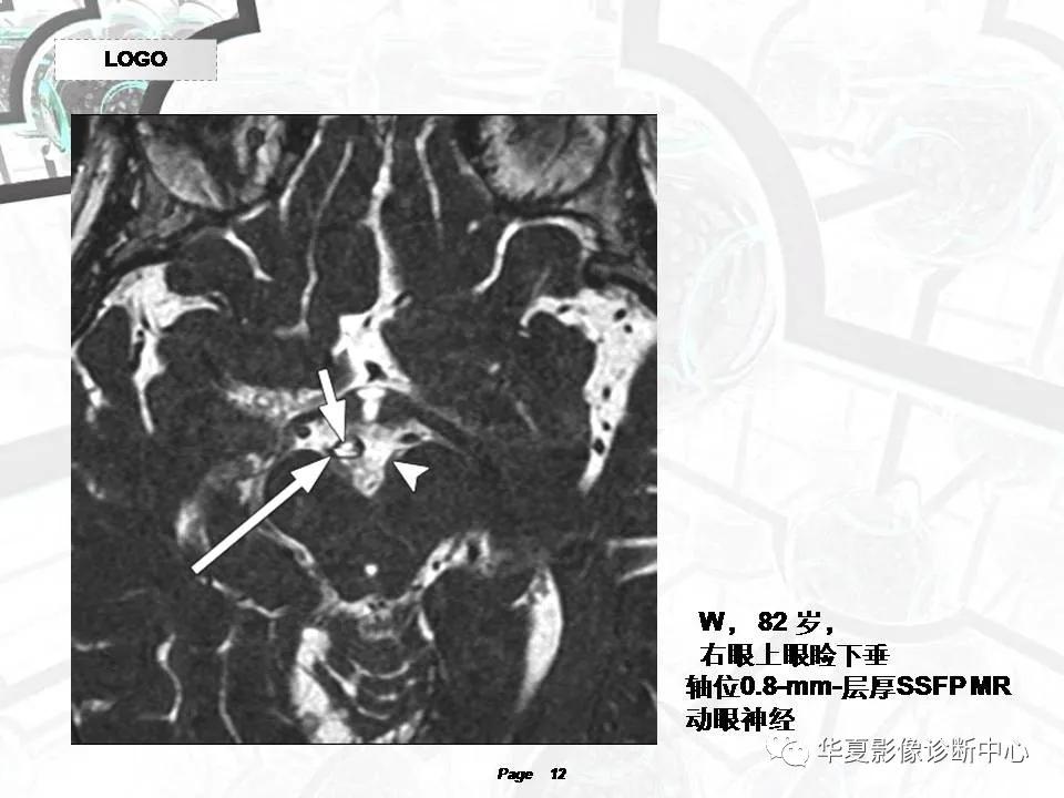 磁共振颅神经扫描是定位在哪,颅神经图谱