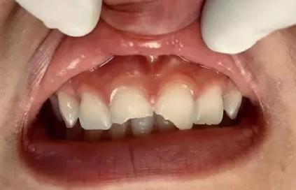 牙齿破损一小点什么原因,牙齿有小黑点医生不处理直接补上