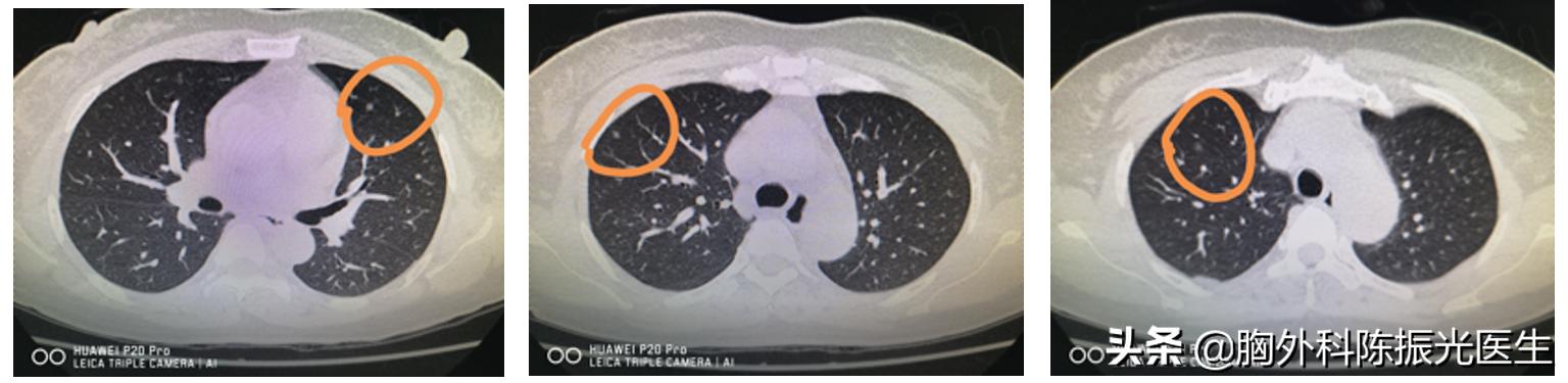天天艾灸为什么会得鼻炎,艾灸可以导致肺结节吗