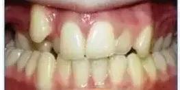 牙齿畸形凸嘴,成人牙齿突出导致凸嘴怎么矫正