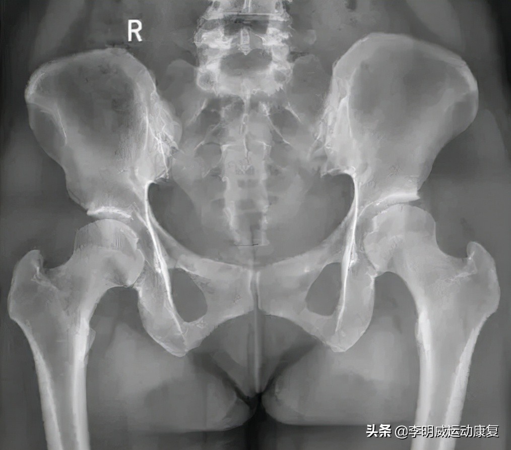 骨盆前倾骨盆不正怎么恢复,骨盆不正会造成什么后果