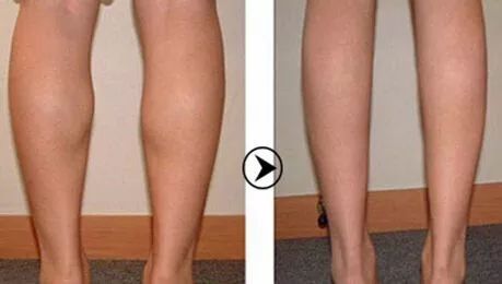 半个月腿粗怎么练腿变细,如何可以瘦小腿让小腿变直变细