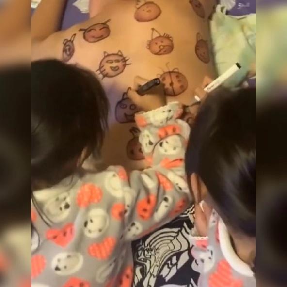 爸爸拔火罐后续,爸爸拔火罐后背留下印记