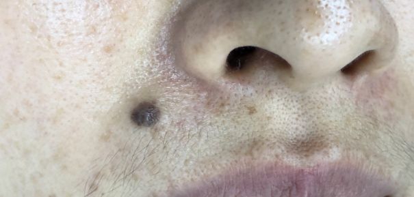 黑色素痣用激光还是手术,痣是手术切除好还是激光好