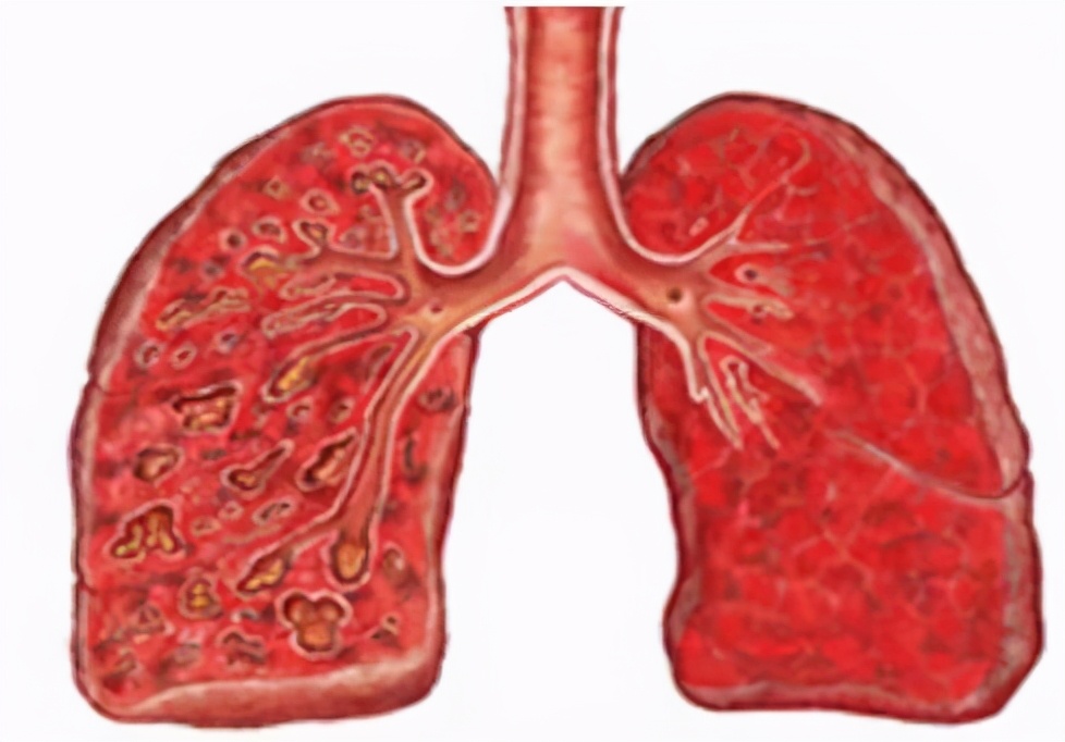 类风湿结节是类风湿关节炎的关节外表现，可运用糖皮质激素治疗