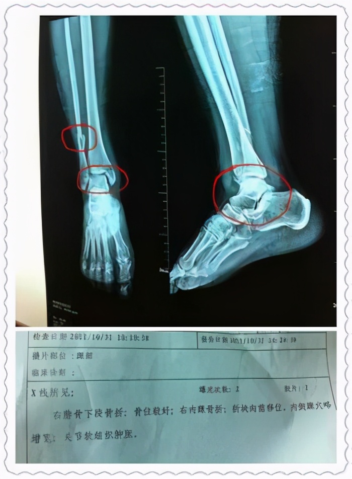 脚丫子都肿是什么原因造成的,脚丫子痛不肿关节痛怎么回事