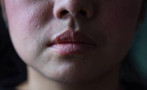 嘴角长泡是上火还是口腔溃疡,口腔内嘴唇起泡是什么原因