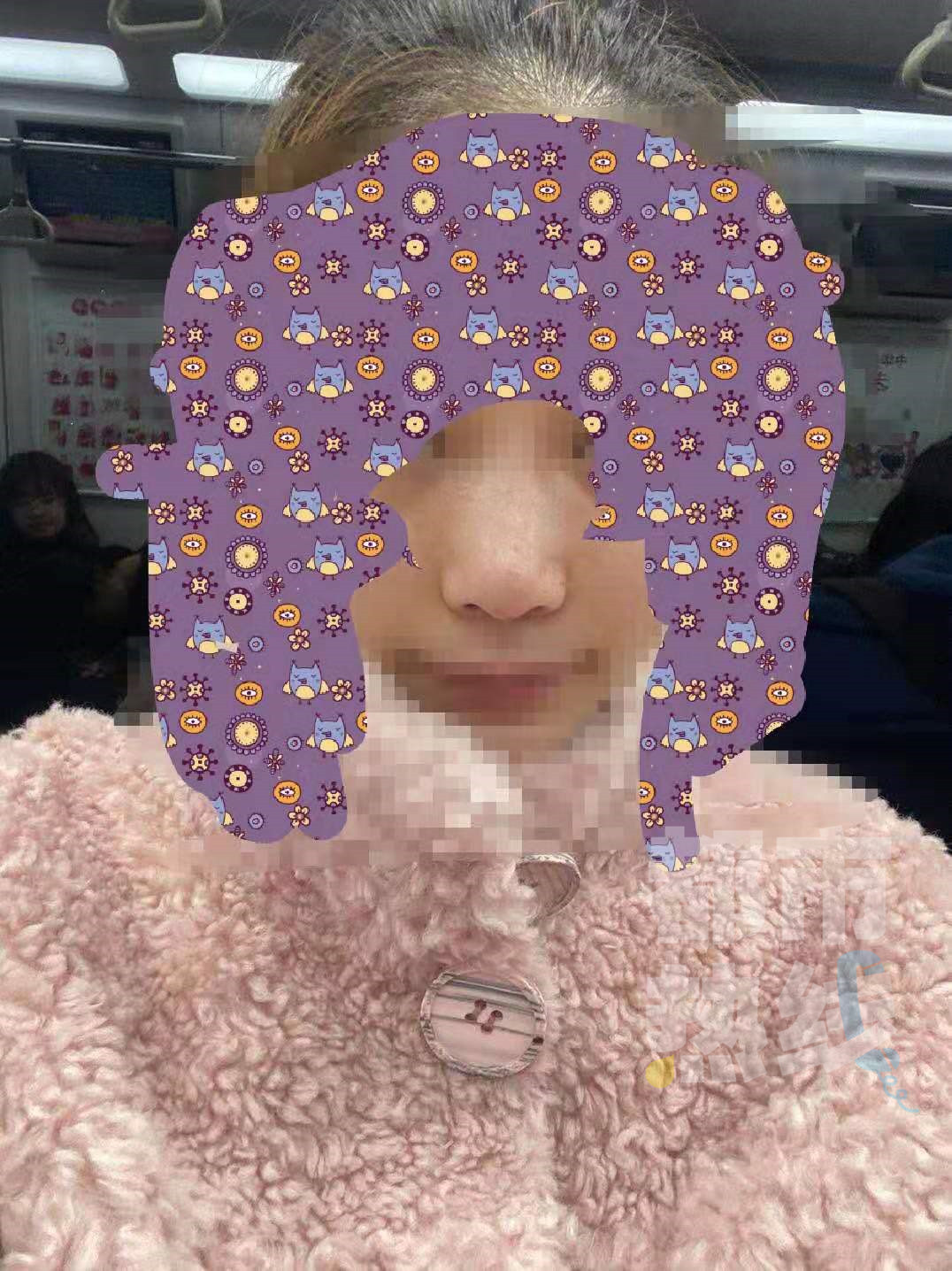 女子花5万西安隆鼻成毁容,西安女子隆鼻后鼻子变歪