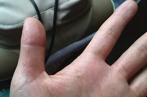 手脚出现水泡还发痒,天热手脚起水泡是怎么回事