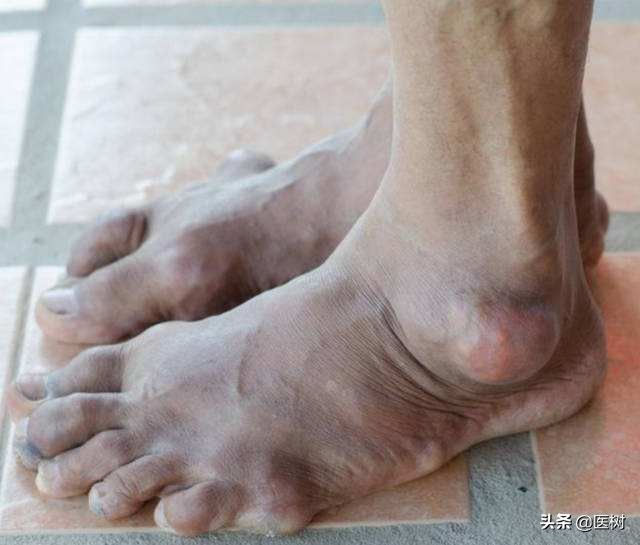 痛风肾衰竭预后怎么样,痛风并肾衰怎样治疗