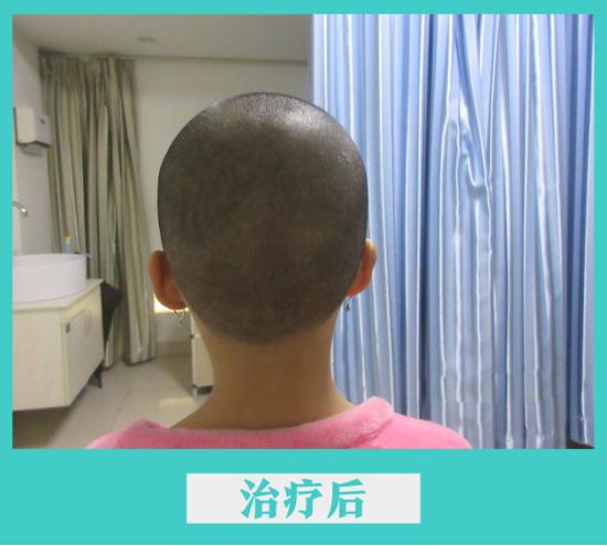 小女孩不慎染上怪病,儿童初发白斑的治愈率