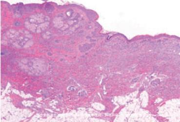 哪些痣医生建议不能祛除,痣对健康有什么威胁如何治疗