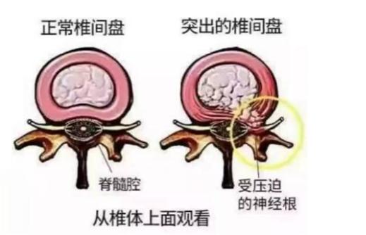 腰椎间盘突出在床上如何锻炼,腰椎间盘突出动作15分钟