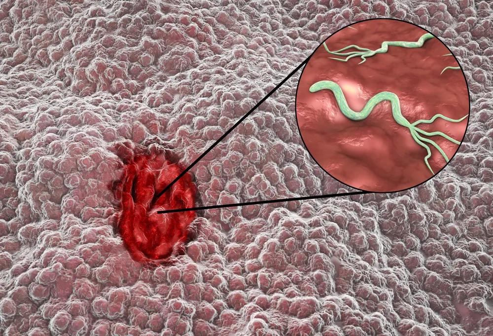 做完支架后容易出的问题,支架后肠胃出血怎么调理