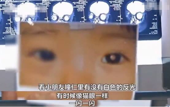 小孩猫眼病症状,猫眼病是儿童的哪种眼病