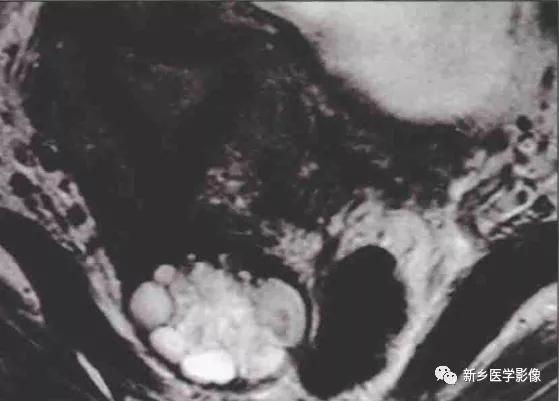 宫颈纳氏囊肿严重吗,宫颈纳氏囊肿