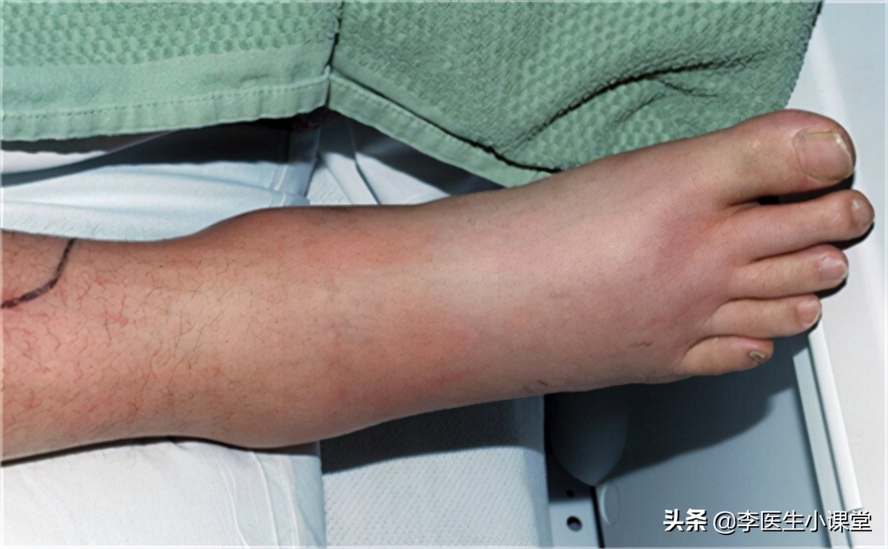 肾功能受损有什么表现,尿有泡沫是肾功能受损吗