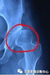 先天性髋关节脱位截骨术全过程,先天性髋关节脱位可以考驾驶证吗