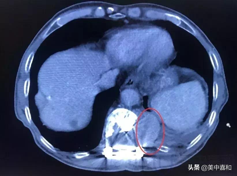 肿瘤引起的腰背部疼有多严重,肿瘤引起的腰疼和腰肌劳损的区别