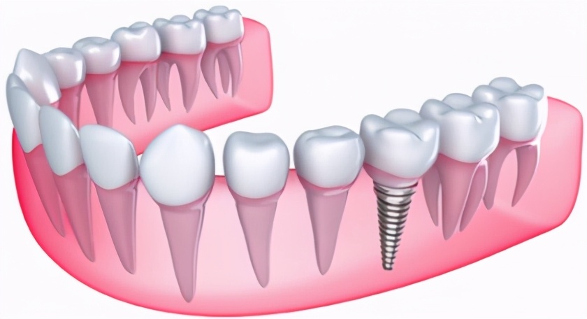 活动假牙和固定假牙的优缺点ppt,活动假牙和固定假牙哪个贵